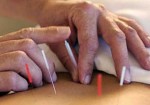 acupuntura-itaquera-1415729151